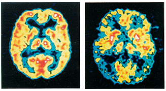 Cerebro normal y cerebro con Alzheimer