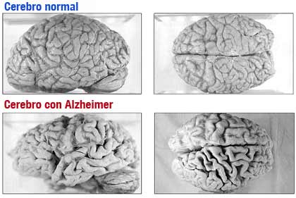 Cerebro normal y con Alzheimer